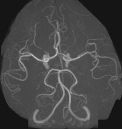 脳血管MRA