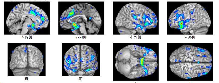 VSRAD（MRI）